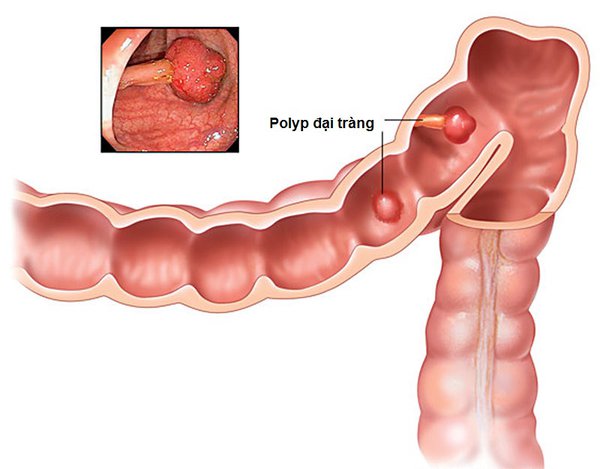 Bị polyp đại tràng có sử dụng được BoniBaio?